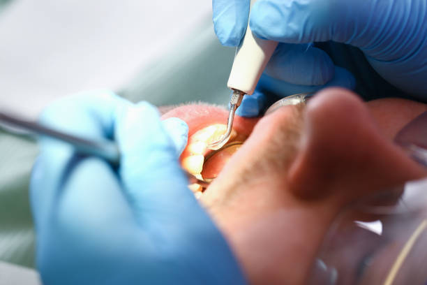 Best Emergency Dentist for Lost Fillings or Crowns in Bluffdale, UT